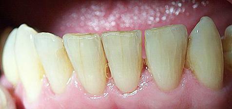 des fissures dans les dents