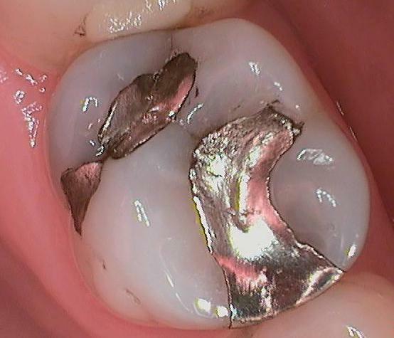 fissure dans la racine de la dent