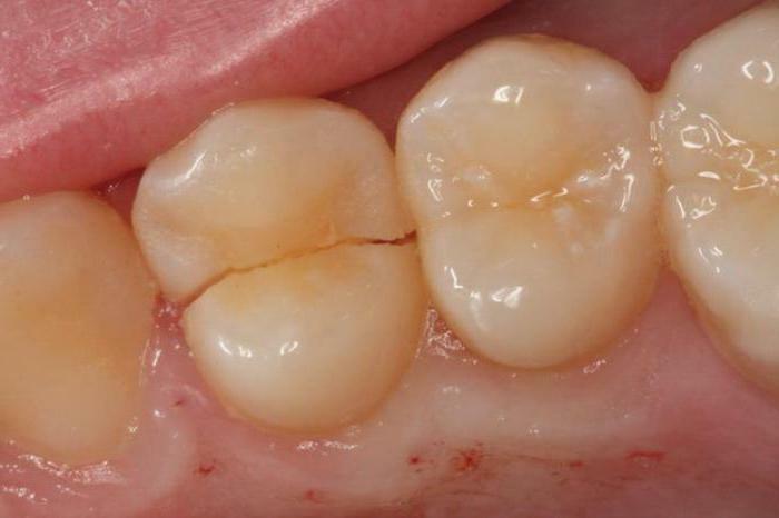 crack na předním zubu