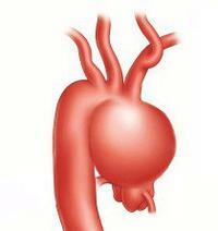 Aneurysma van de opgaande aorta