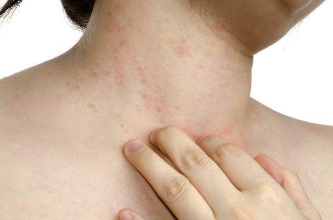 alergiju na vrat