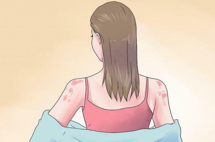 punti di allergia sul collo