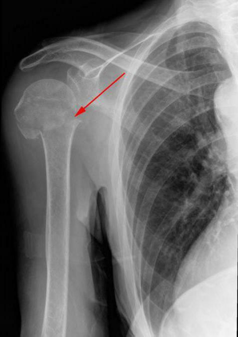 arthrosis of the shoulder joint causes the symptoms of the degree