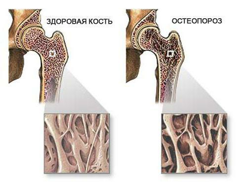 osteoporosi diffusa delle ossa